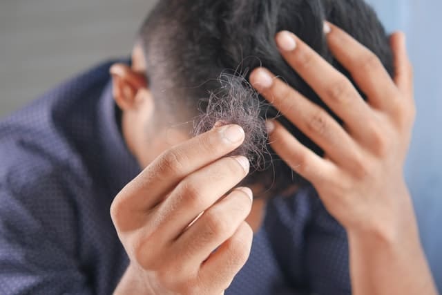 Få håret tilbage efter alopecia